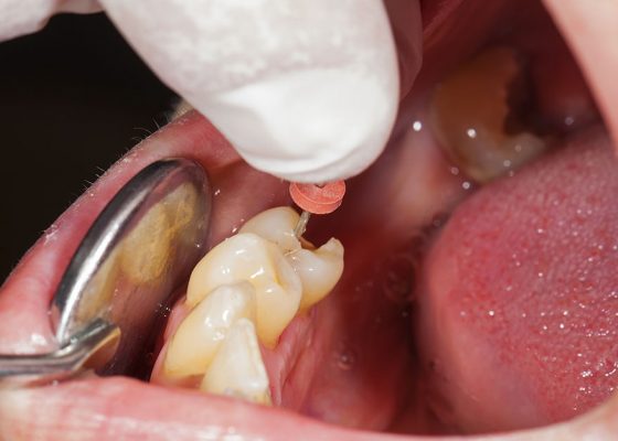 i-endodoncia i-endodoncia
